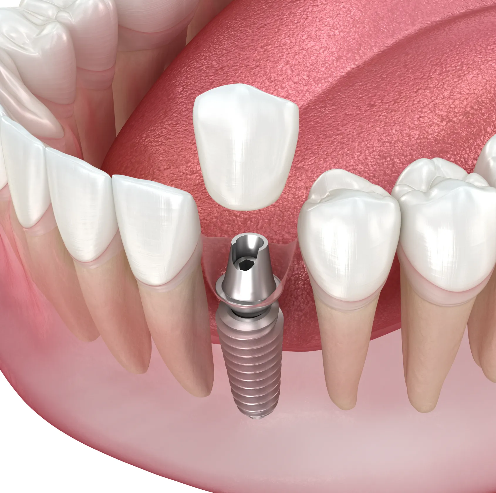 3D illustration of a dental implant with an abutment and crown positioned between natural teeth in the lower jaw.