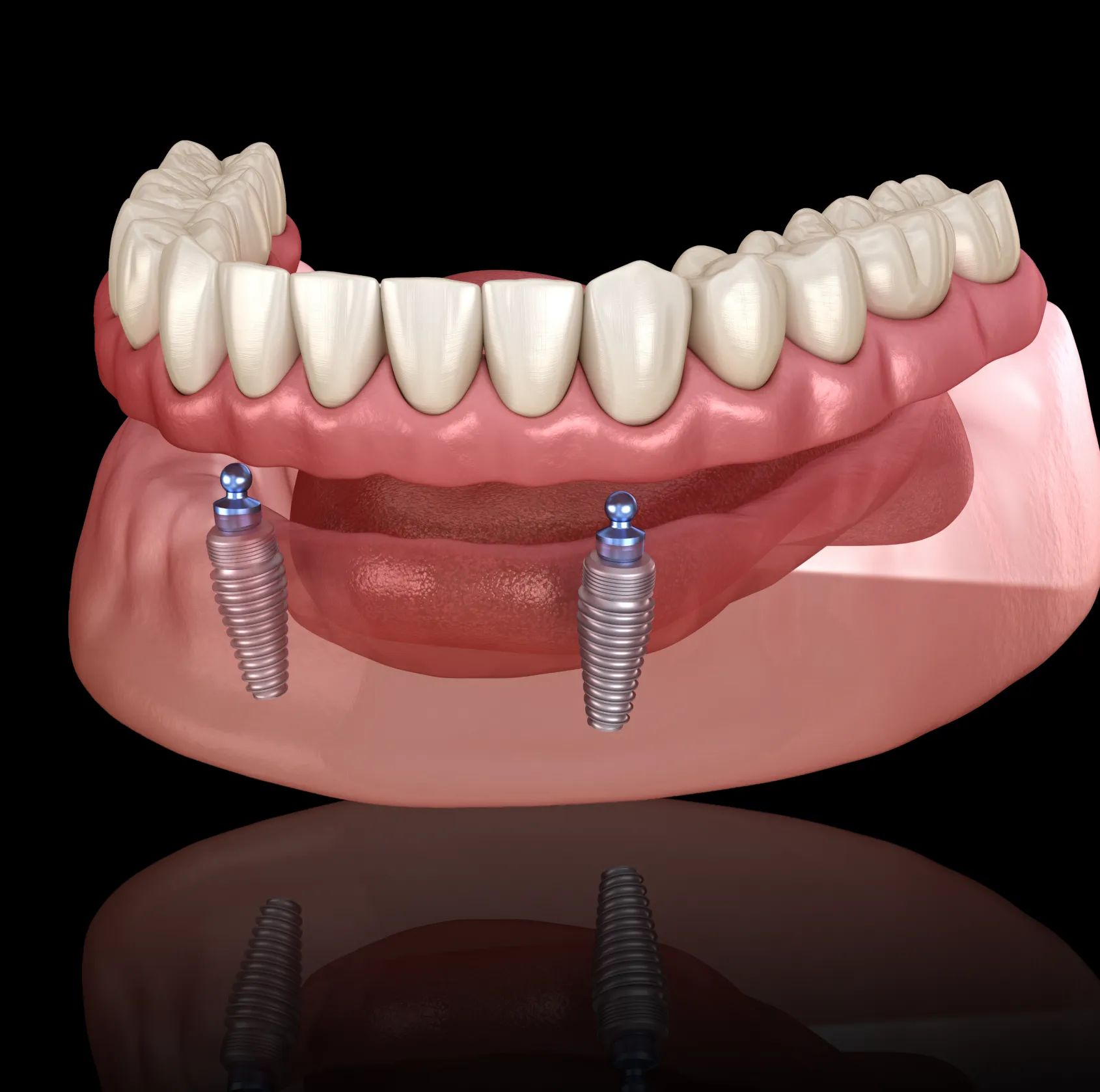 3D illustration of lower jaw showing dental implants with attached denture.
