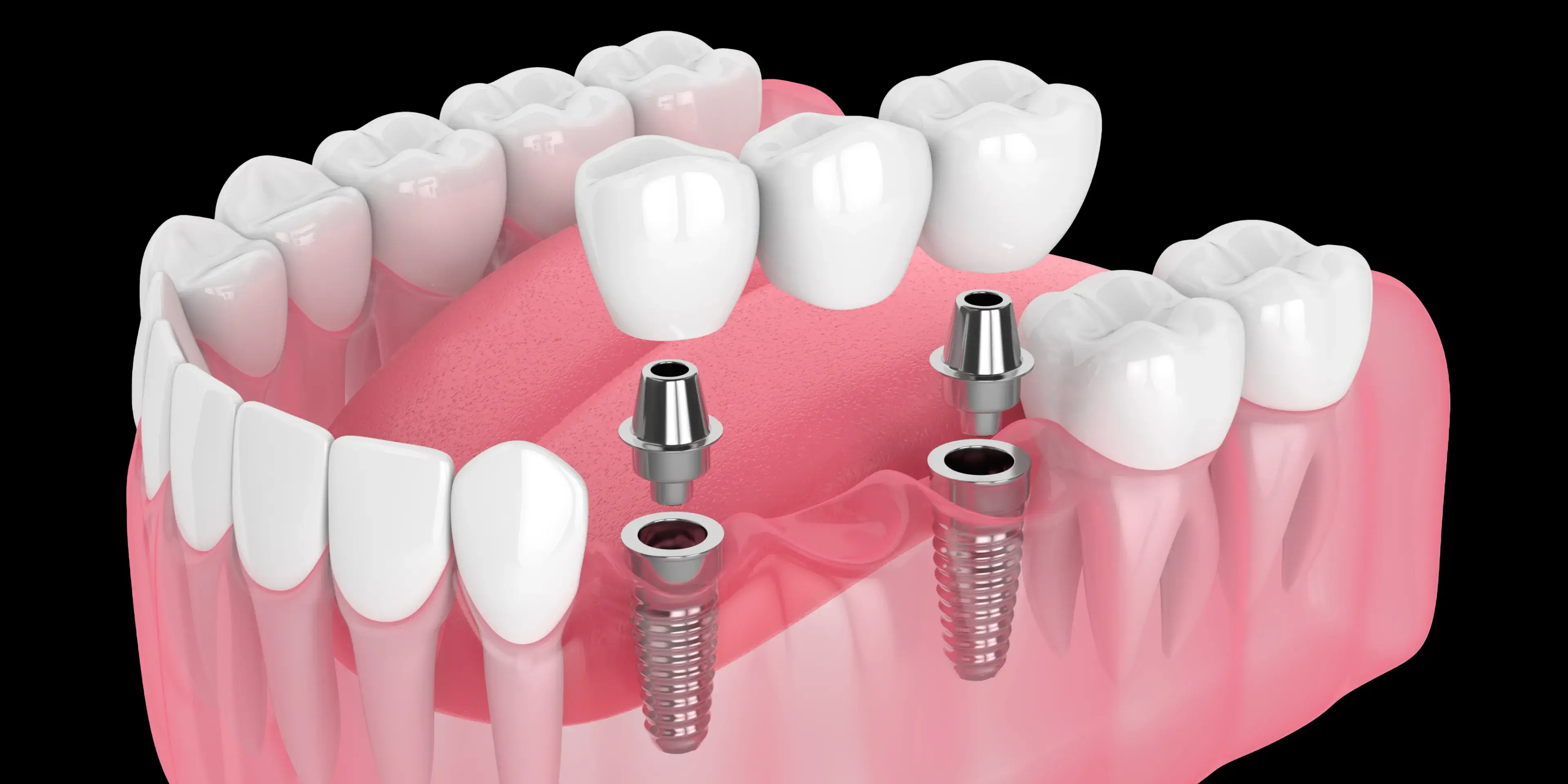 3D illustration of lower jaw with two dental implants and abutments ready for crown placement.