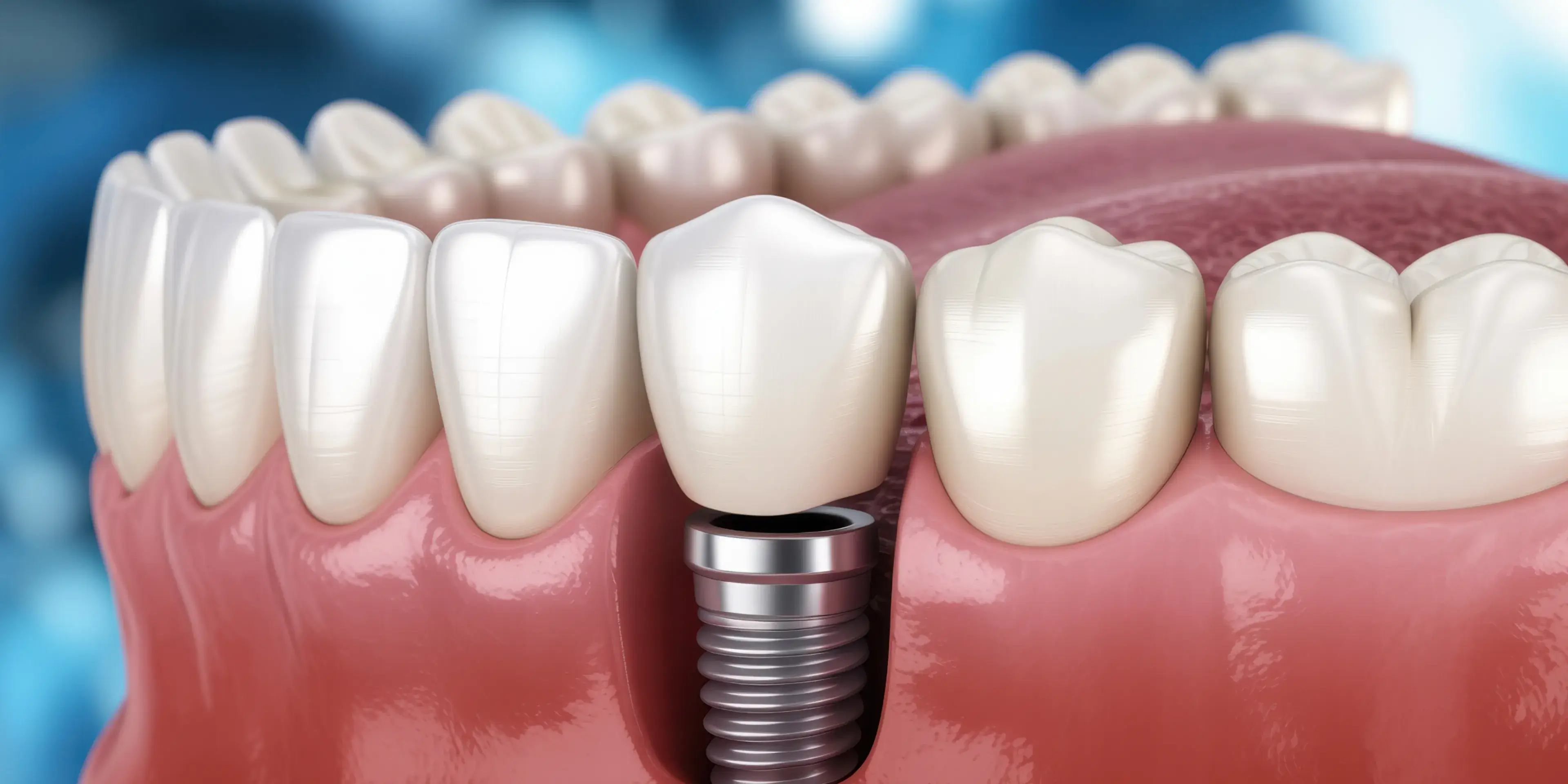 Illustration of a dental implant with a metal screw inserted into the gum and a crown attached on top.