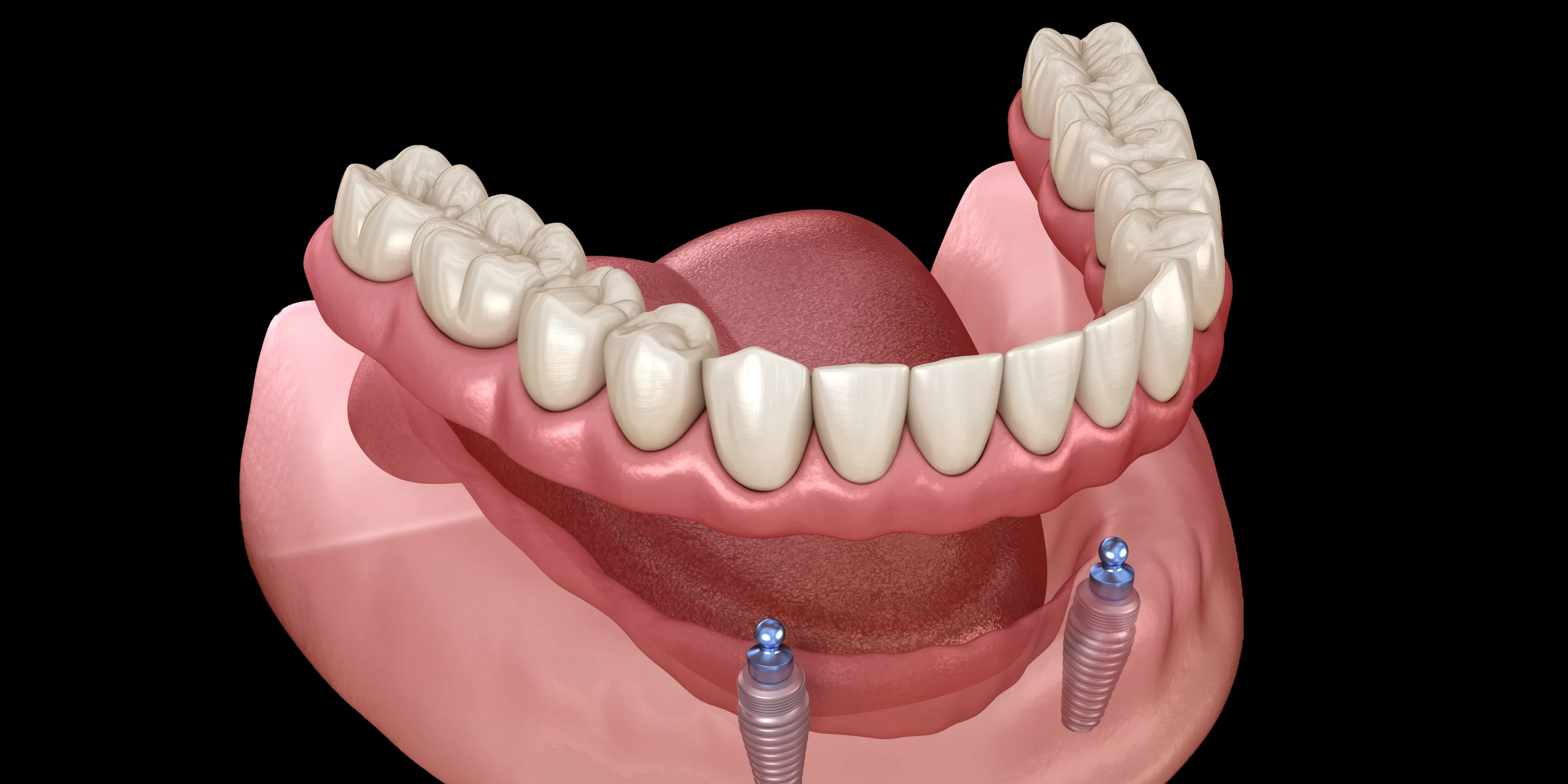 3D illustration of a lower denture supported by two dental implants in the jawbone with visible pink gums and tongue.
