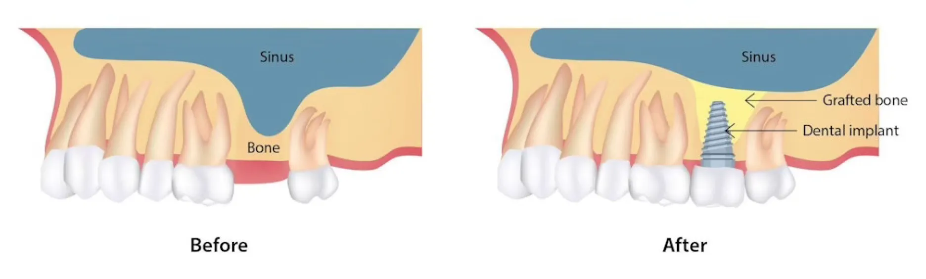Side-by-side illustration showing a dental sinus lift before and after the procedure; before shows low bone height under the sinus, after shows grafted bone and a dental implant placed under the sinus.