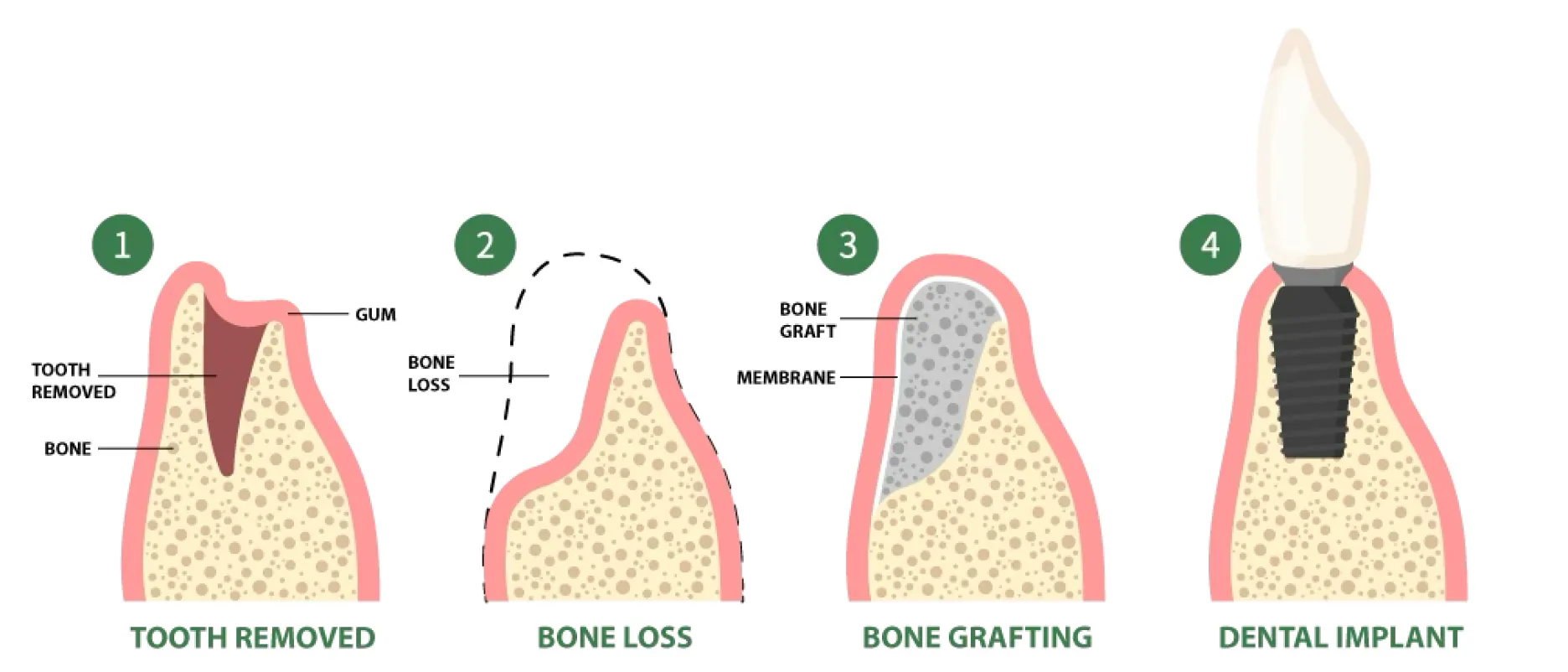 Four-step dental illustration showing tooth removal with gum and bone, bone loss outline, bone graft with membrane placement, and final dental implant in bone.