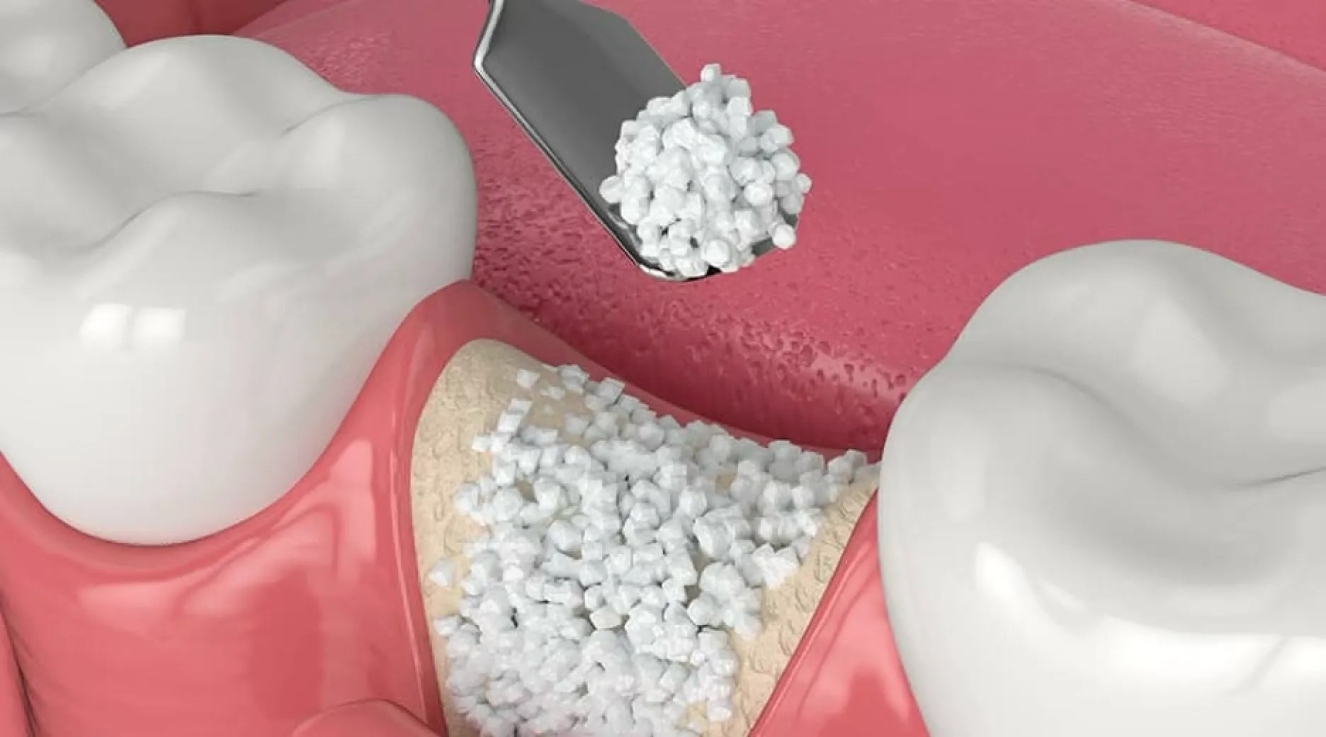 Close-up 3D illustration of dental bone graft material being packed into a gum area between teeth.
