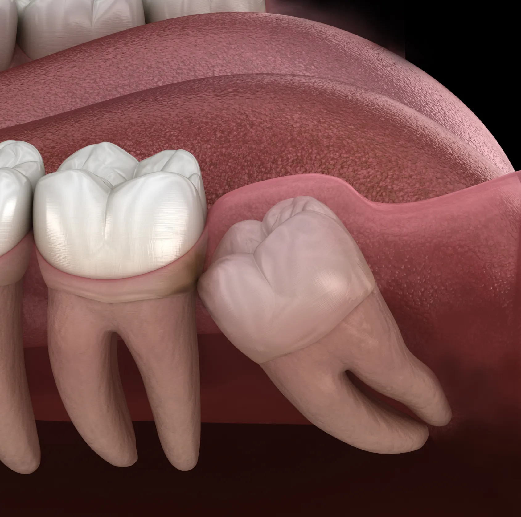 3D illustration of an impacted wisdom tooth growing horizontally under the gum next to normal molars.