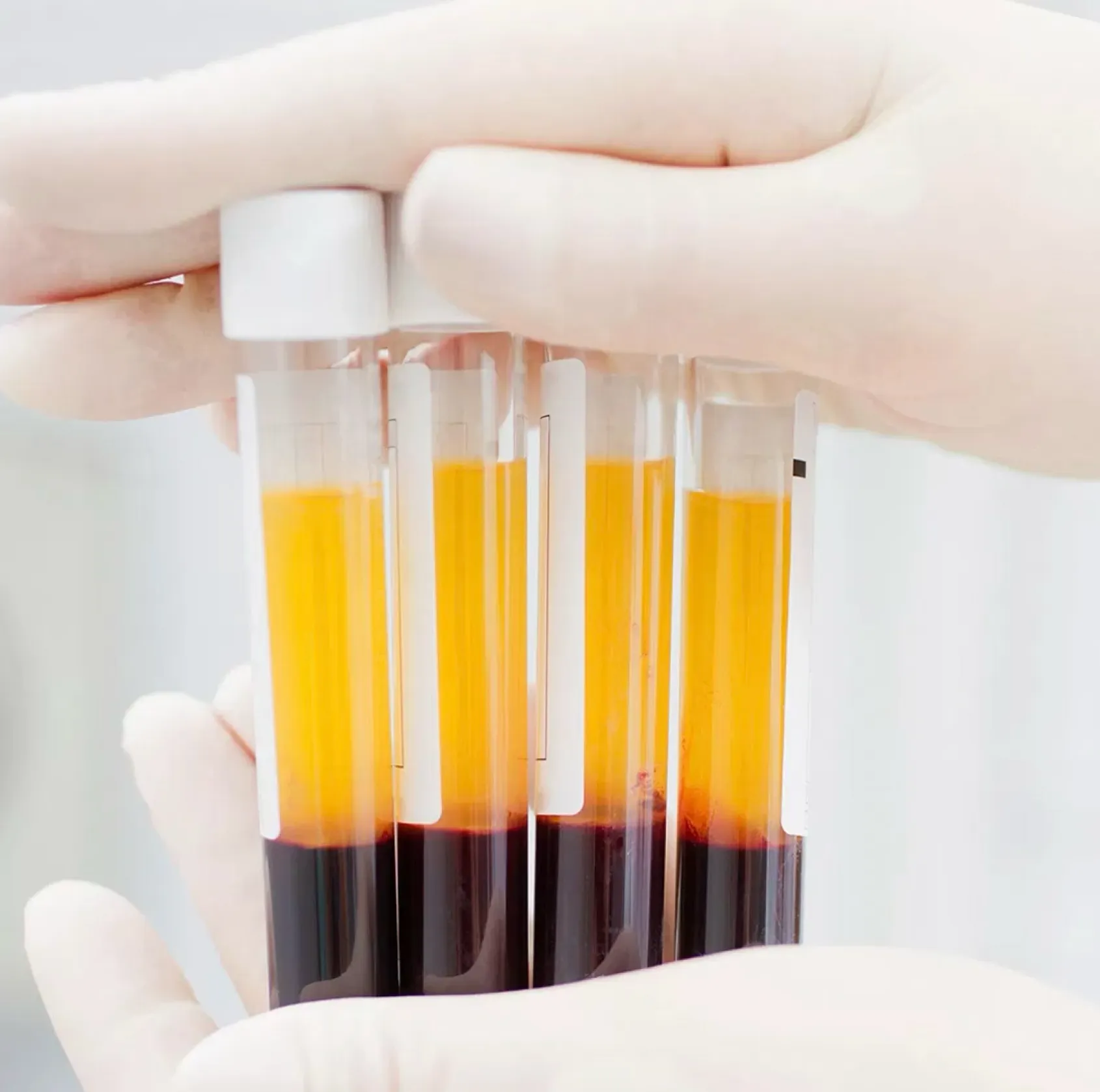 Close-up of gloved hand holding several blood samples in test tubes showing clear separation of plasma and red blood cells.