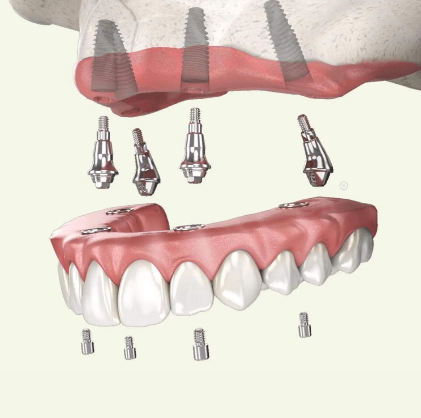 Full-Arch Restoration (All-on-4)