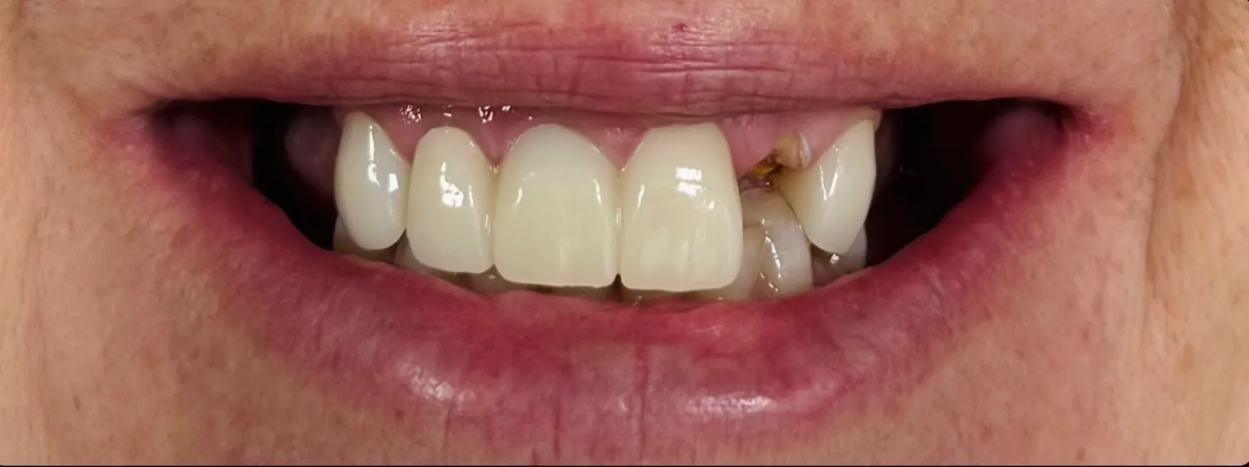 Before Dental Procedure