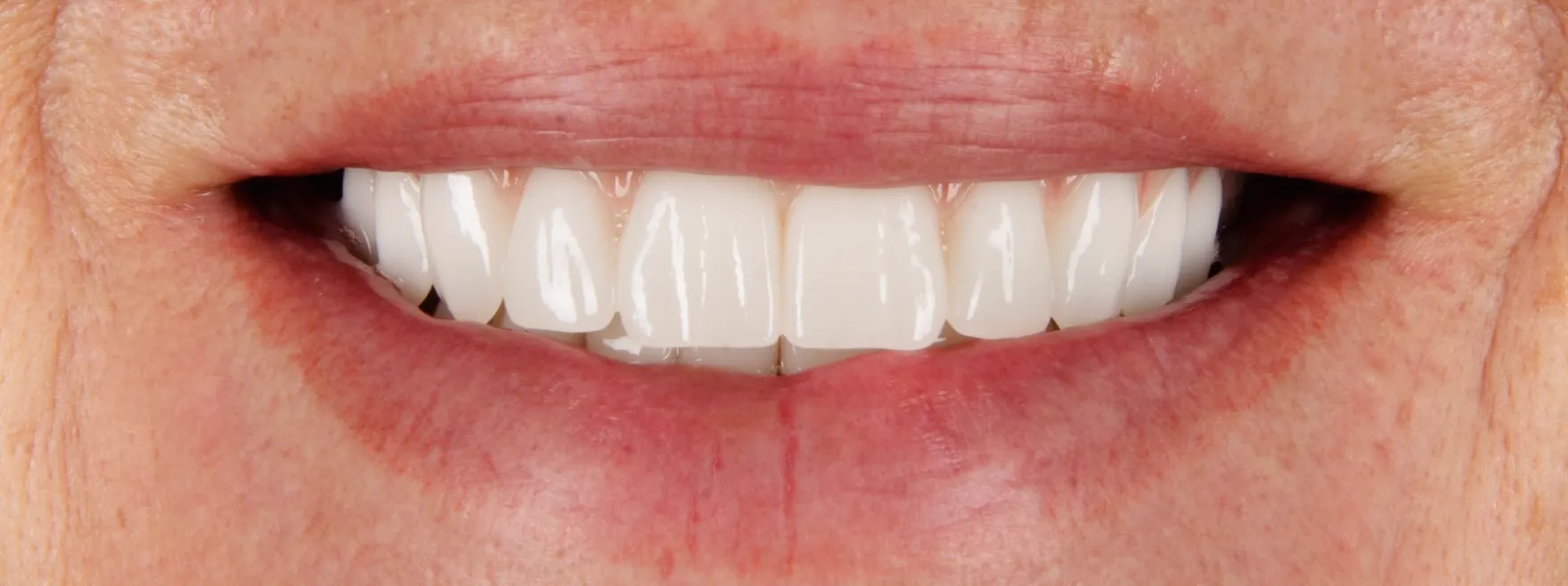 After Dental Procedure