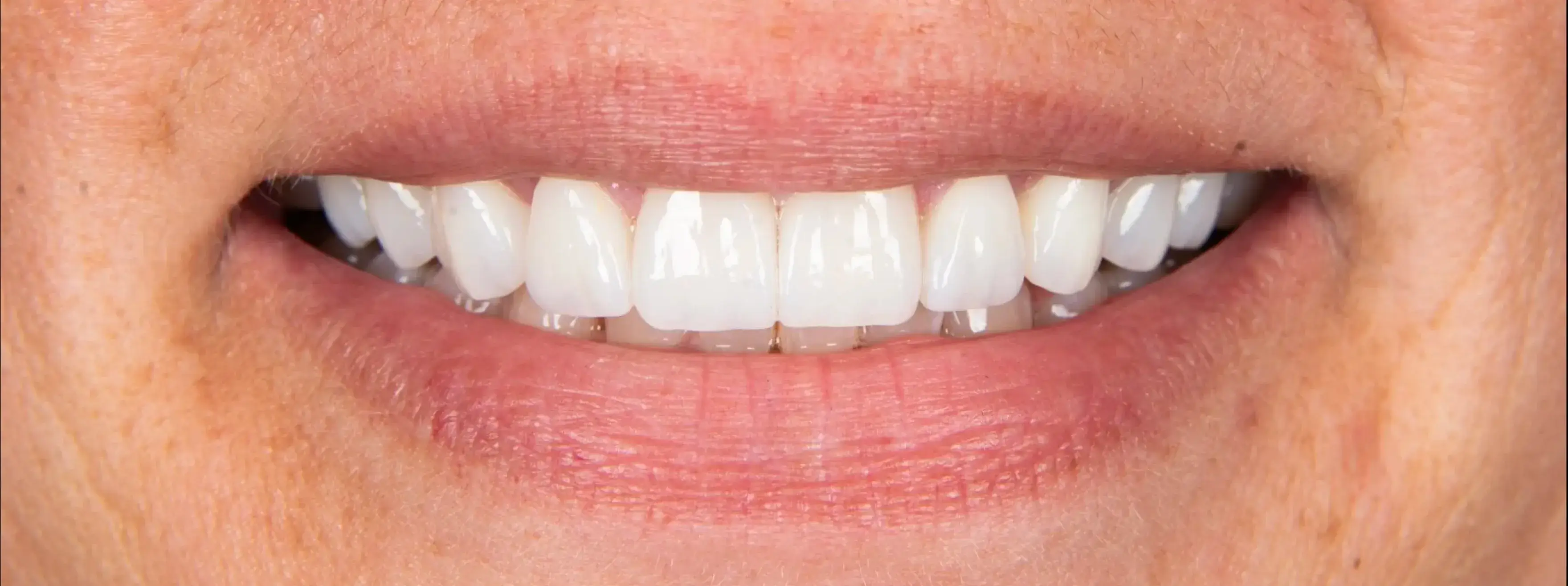 After Dental Procedure