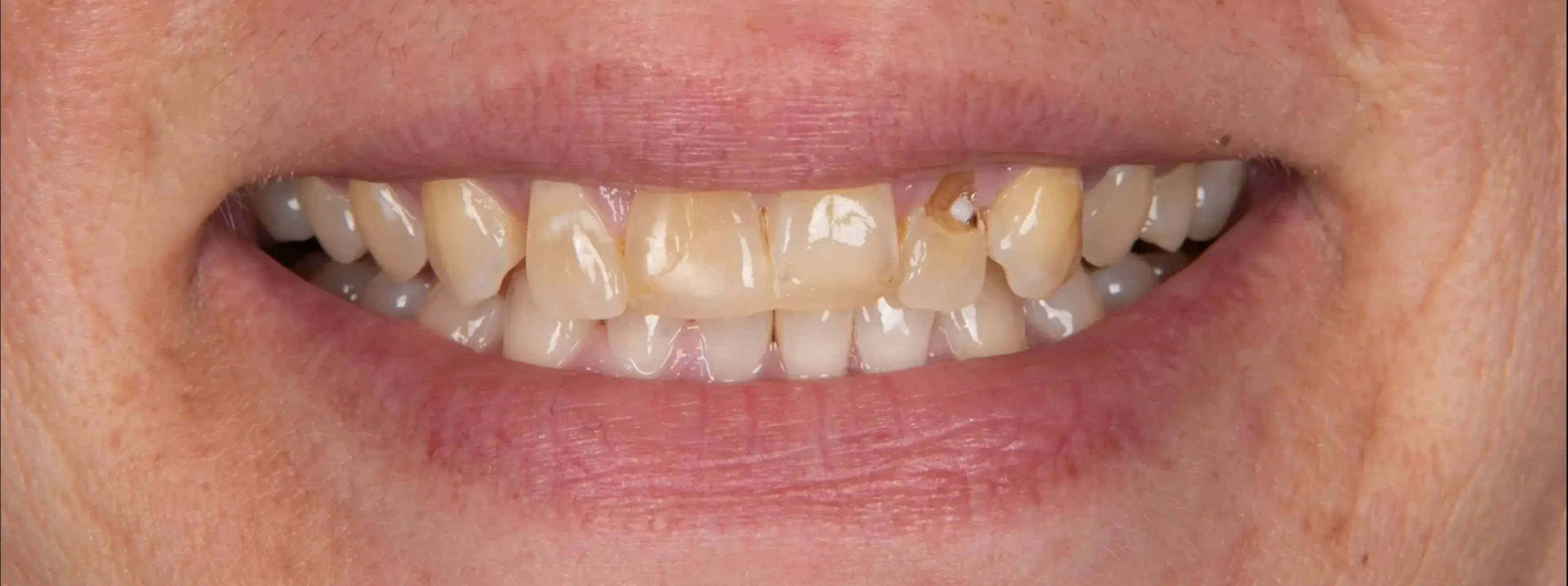 Before Dental Procedure