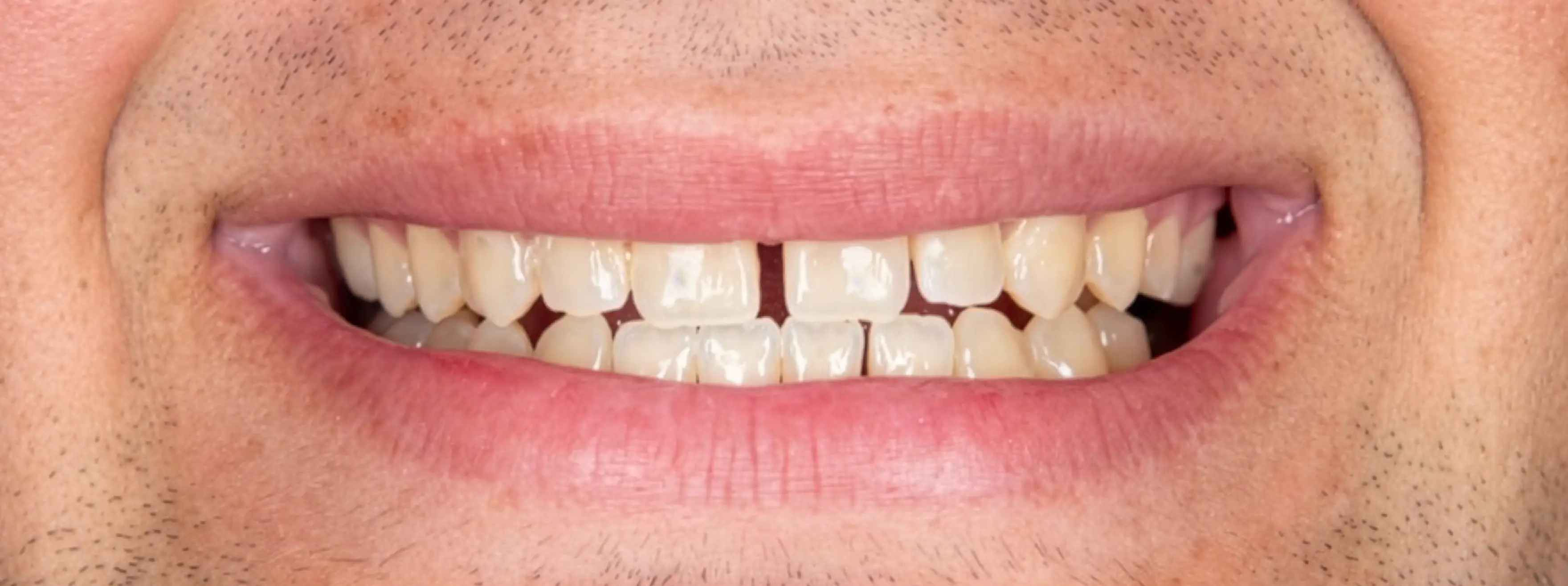 Before Dental Procedure