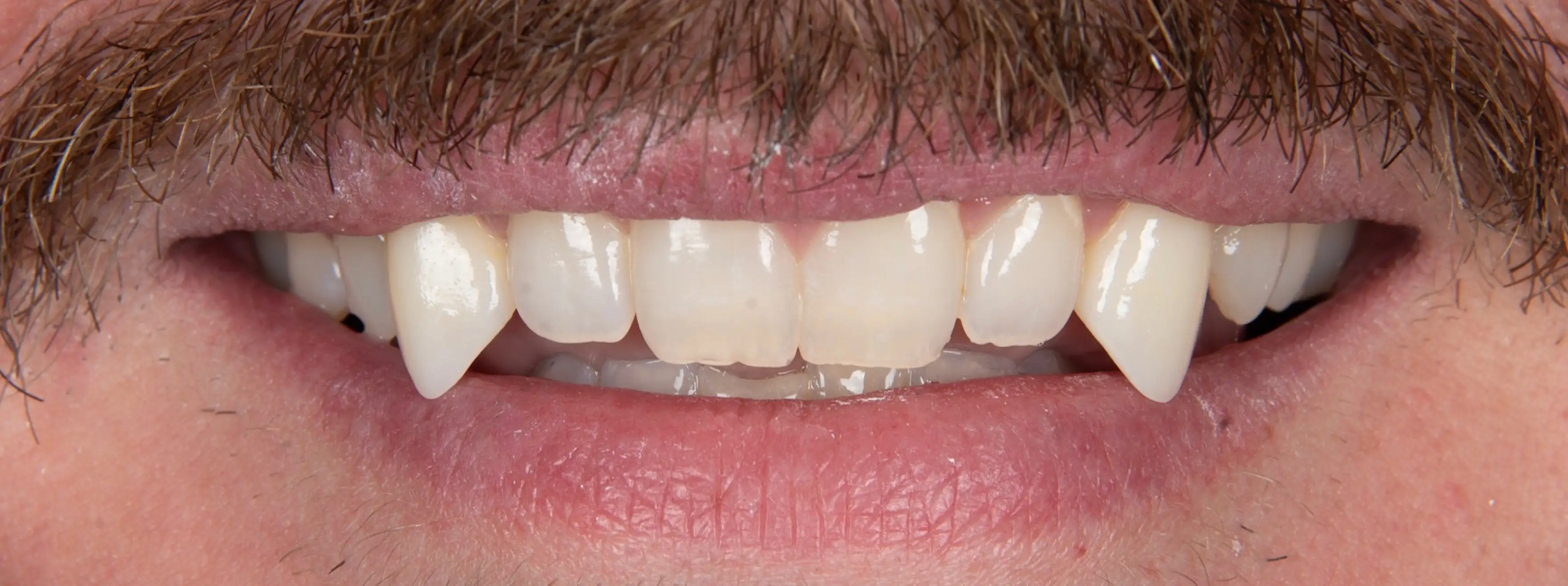 After Dental Procedure