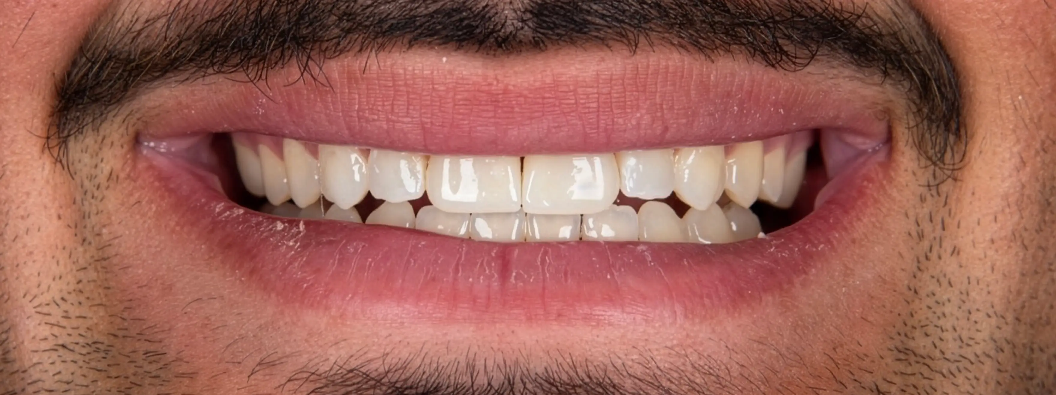After Dental Procedure
