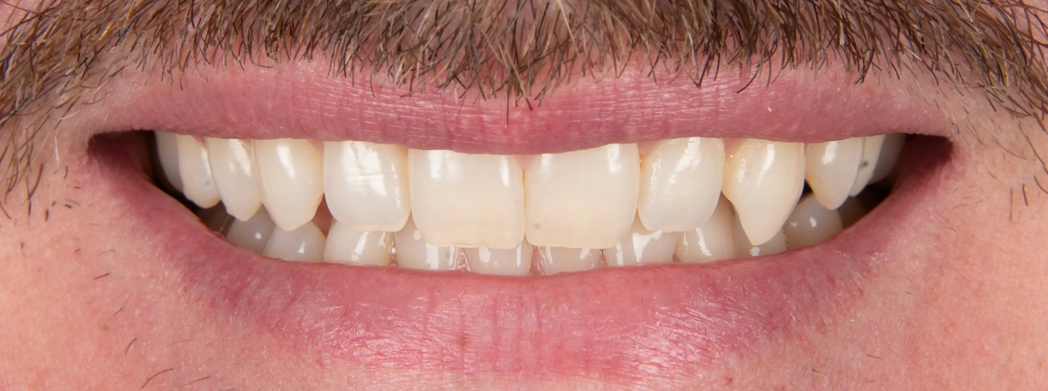 Before Dental Procedure