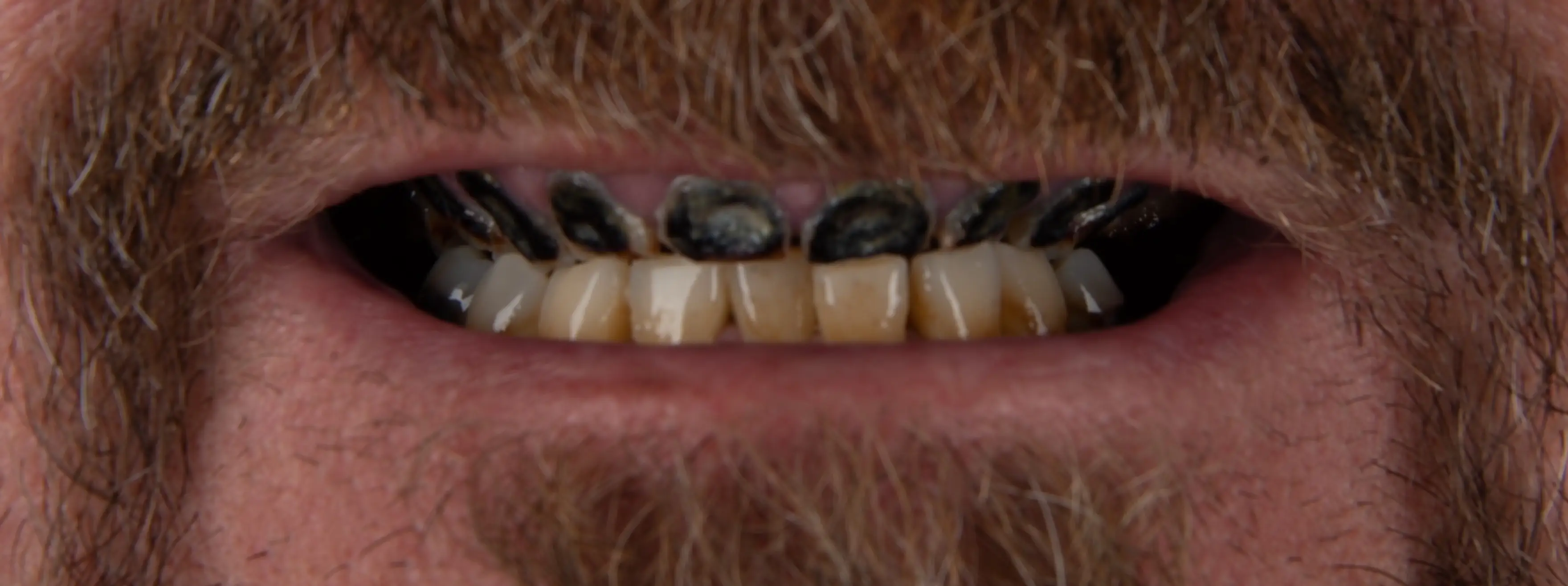 Before Dental Procedure
