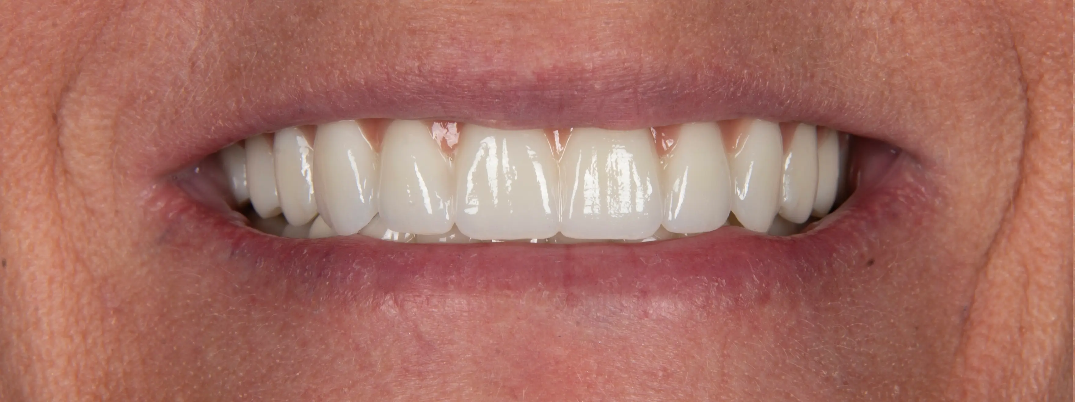 After Dental Procedure