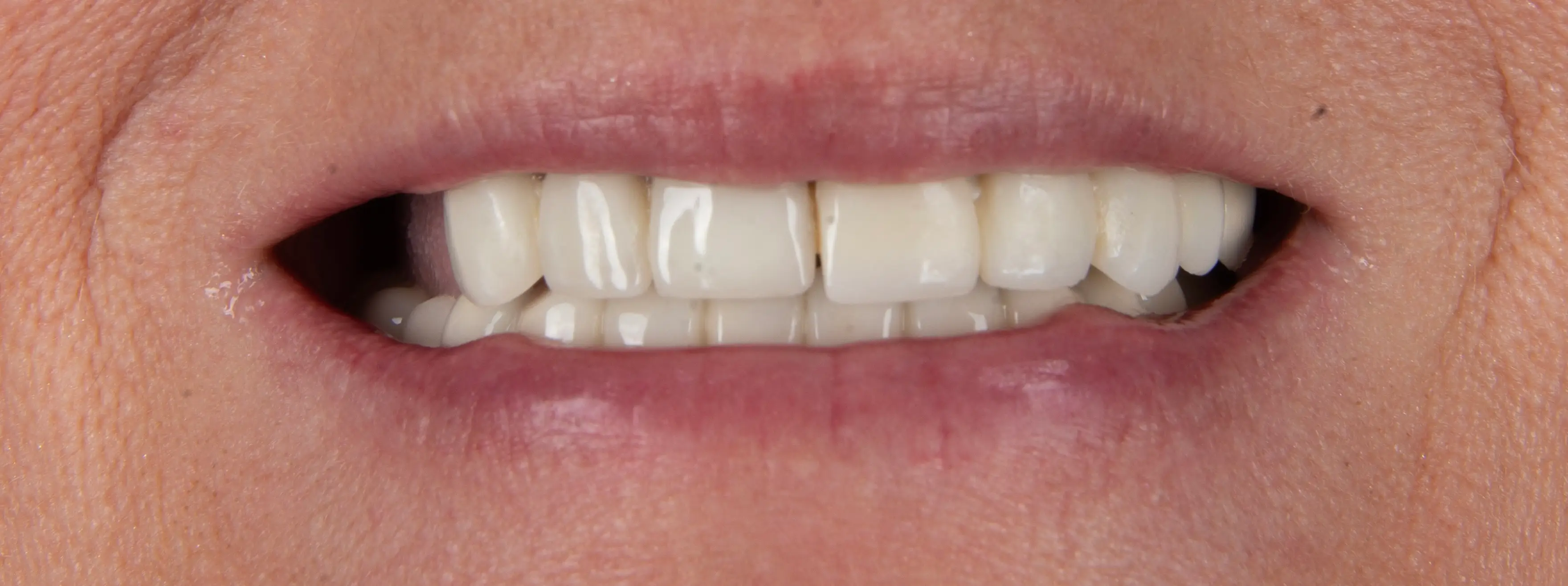 Before Dental Procedure