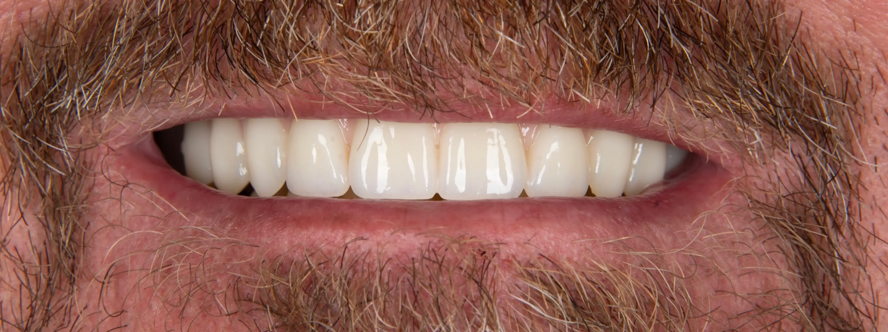 After Dental Procedure