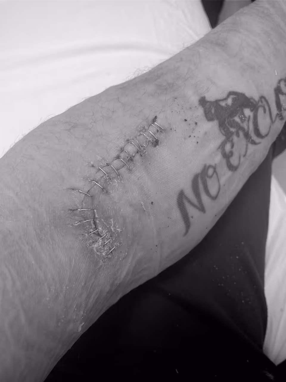 Close-up of a forearm with surgical staples closing a curved wound near a tattoo that partially reads ‘No e’