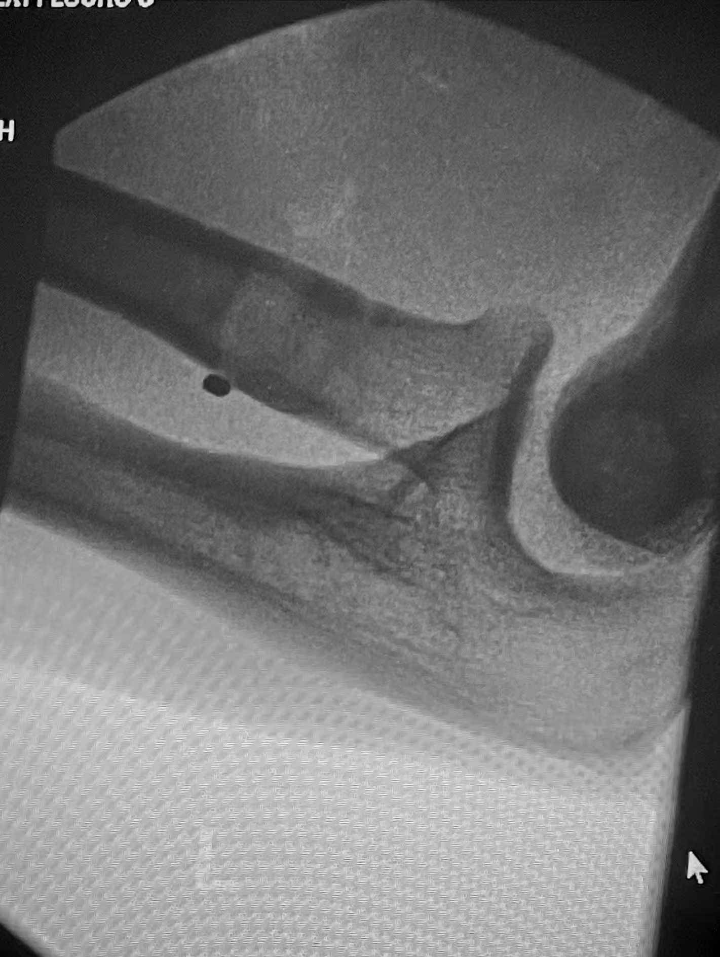 X-ray image showing a bone fracture in the ankle area with visible bone fragments.