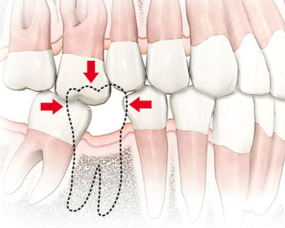 Illustration of a lower jaw showing a partially erupted wisdom tooth pushing against other teeth. Red arrows and dashed lines highlight potential movement direction of teeth after a tooth is lost