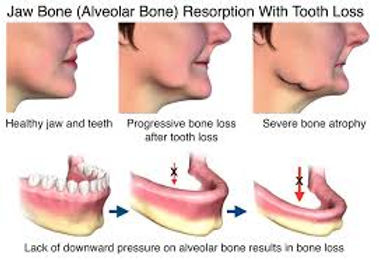 Diagram showing jawbone resorption stages with tooth loss: healthy jaw, progressive bone loss, severe atrophy. Includes explanatory text.