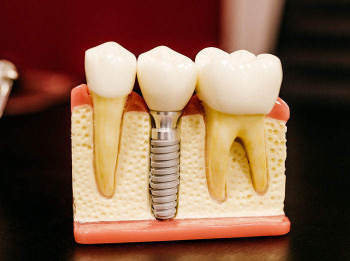 Dental model showing two natural teeth and a metal implant in a gum section; background is blurred dark red and black.