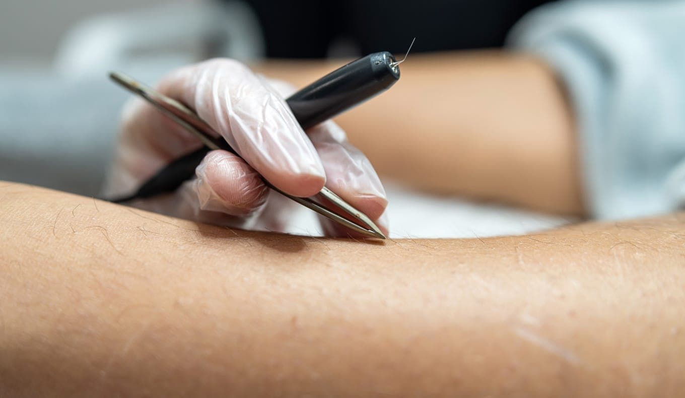 Épilation Électrolyse