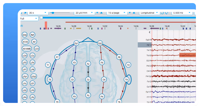 EEG monitoring interface showing a brain diagram with electrode placements and corresponding waveforms on the right side.