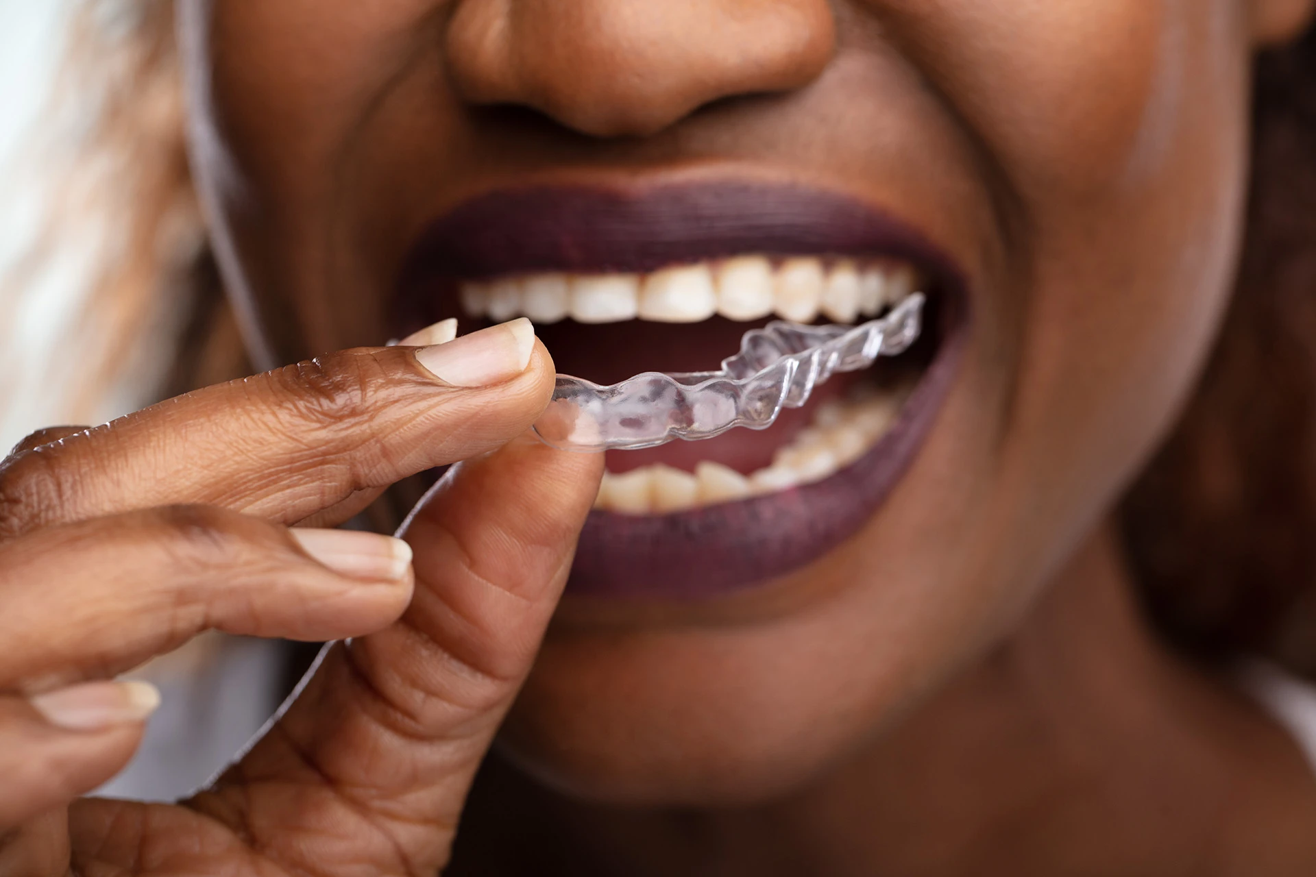 Close-up of a person with dark skin holding a clear dental aligner near their mouth, showing their teeth.
