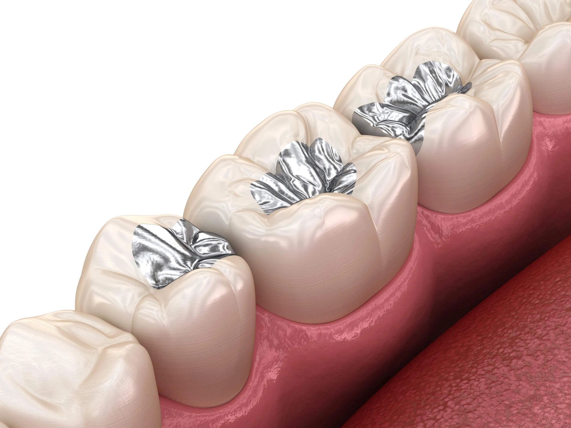 Dental Sealants in Bronx NY