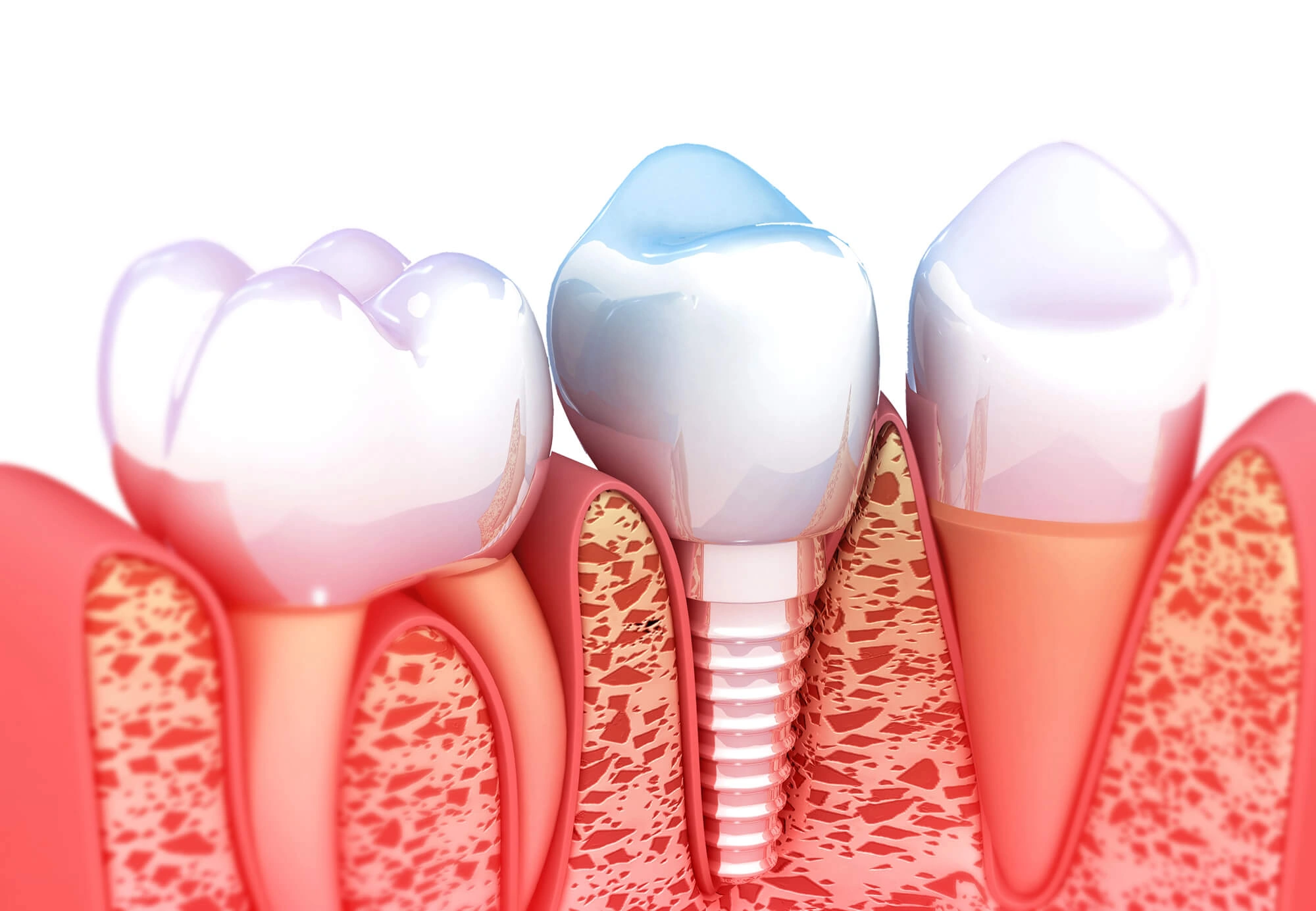 Dental Implants Bronx NY