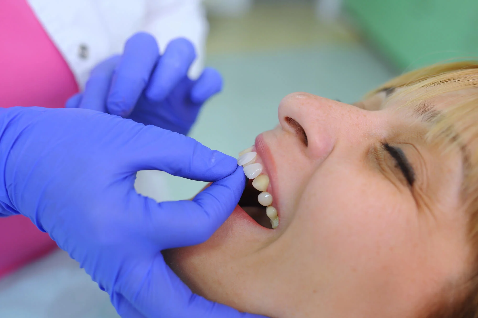 Veneers Bronx NY