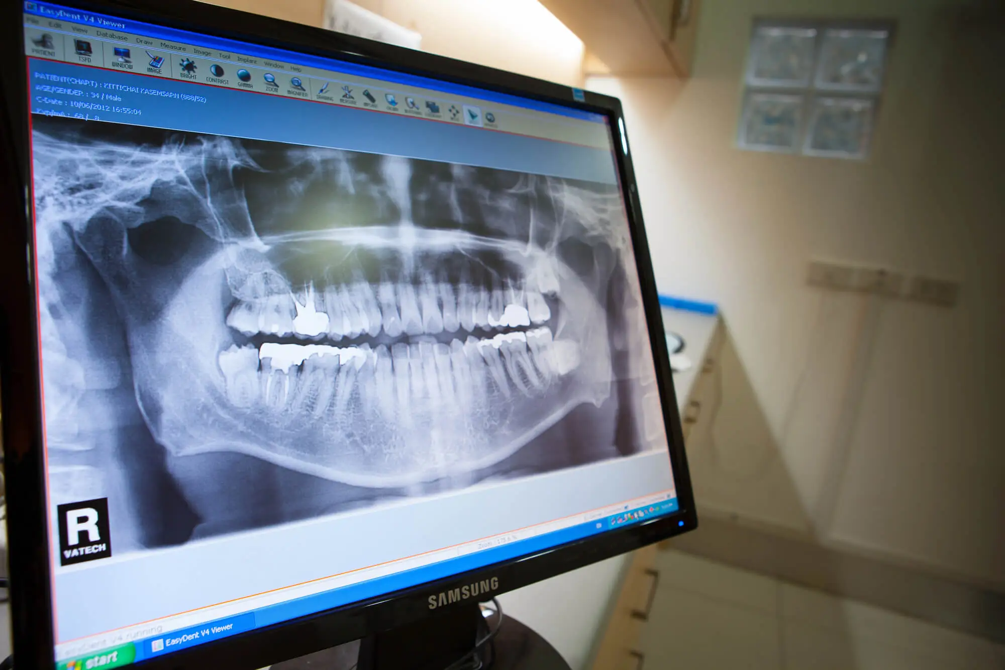 How Long Do Dental Crowns in Queens Last