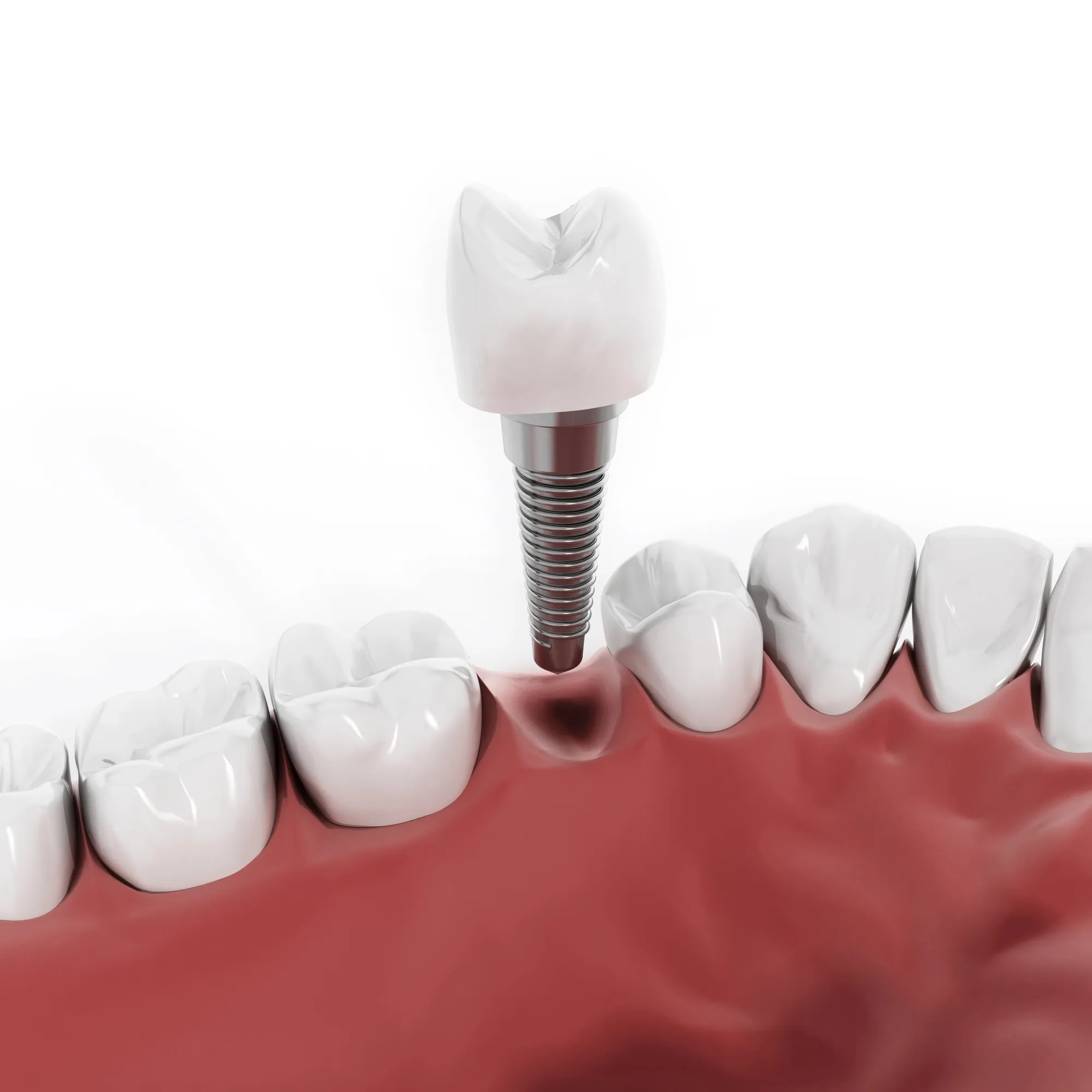 dental-implants-in-queens-single-tooth-implant