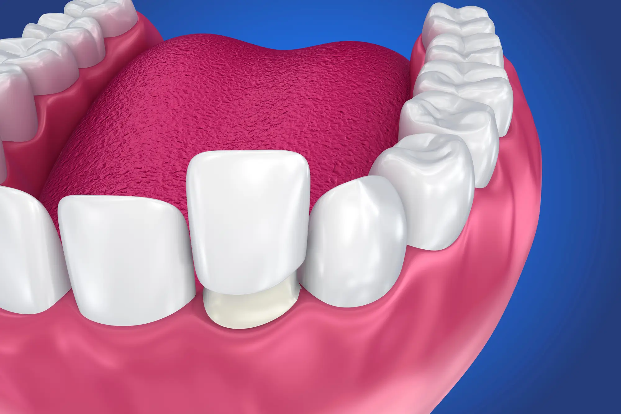 Porcelain Veneers from Cosmetic Dentist in Westchester County, NY