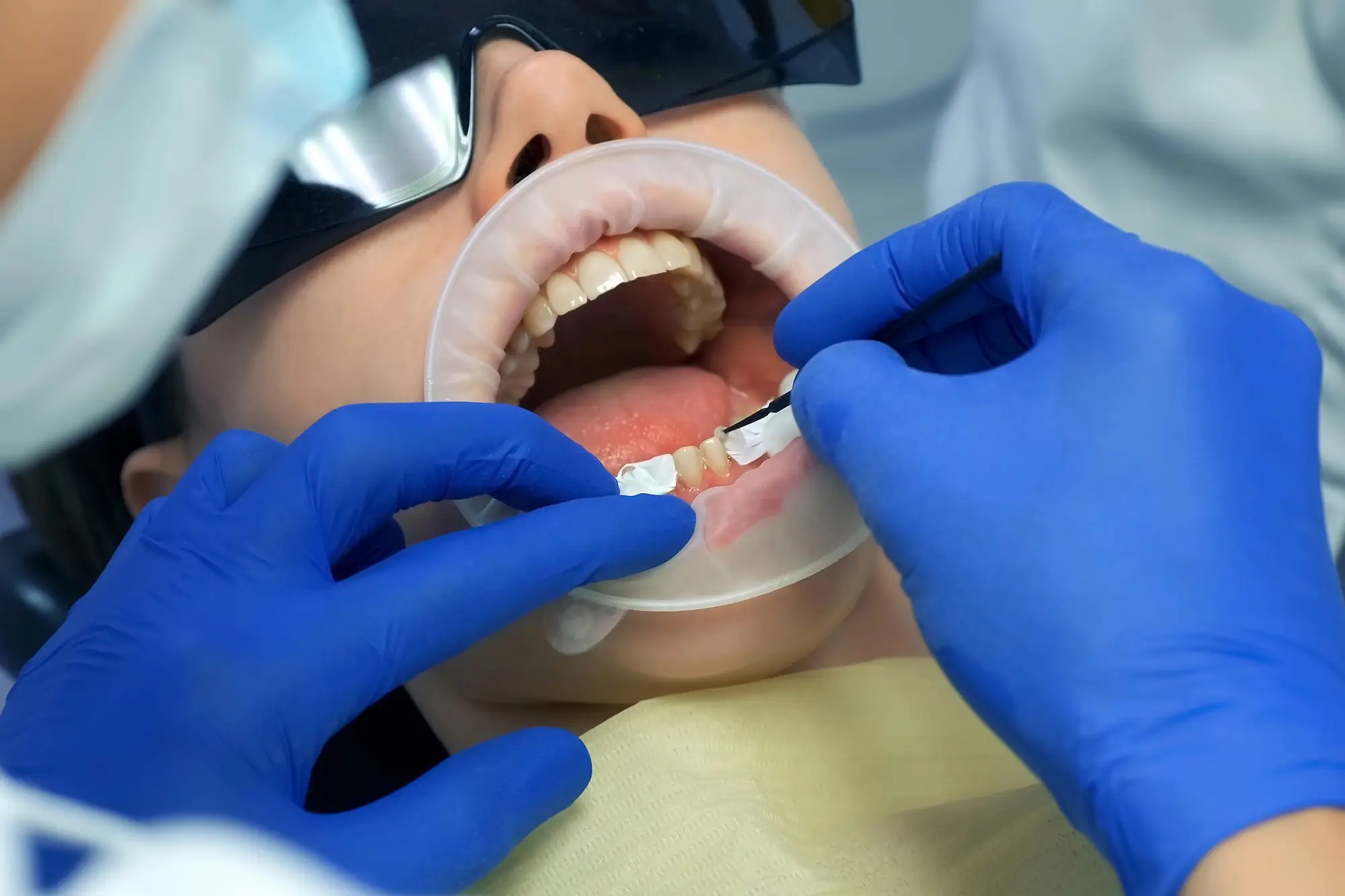 Veneer Preparation by Cosmetic Dentist in Westchester County, NY
