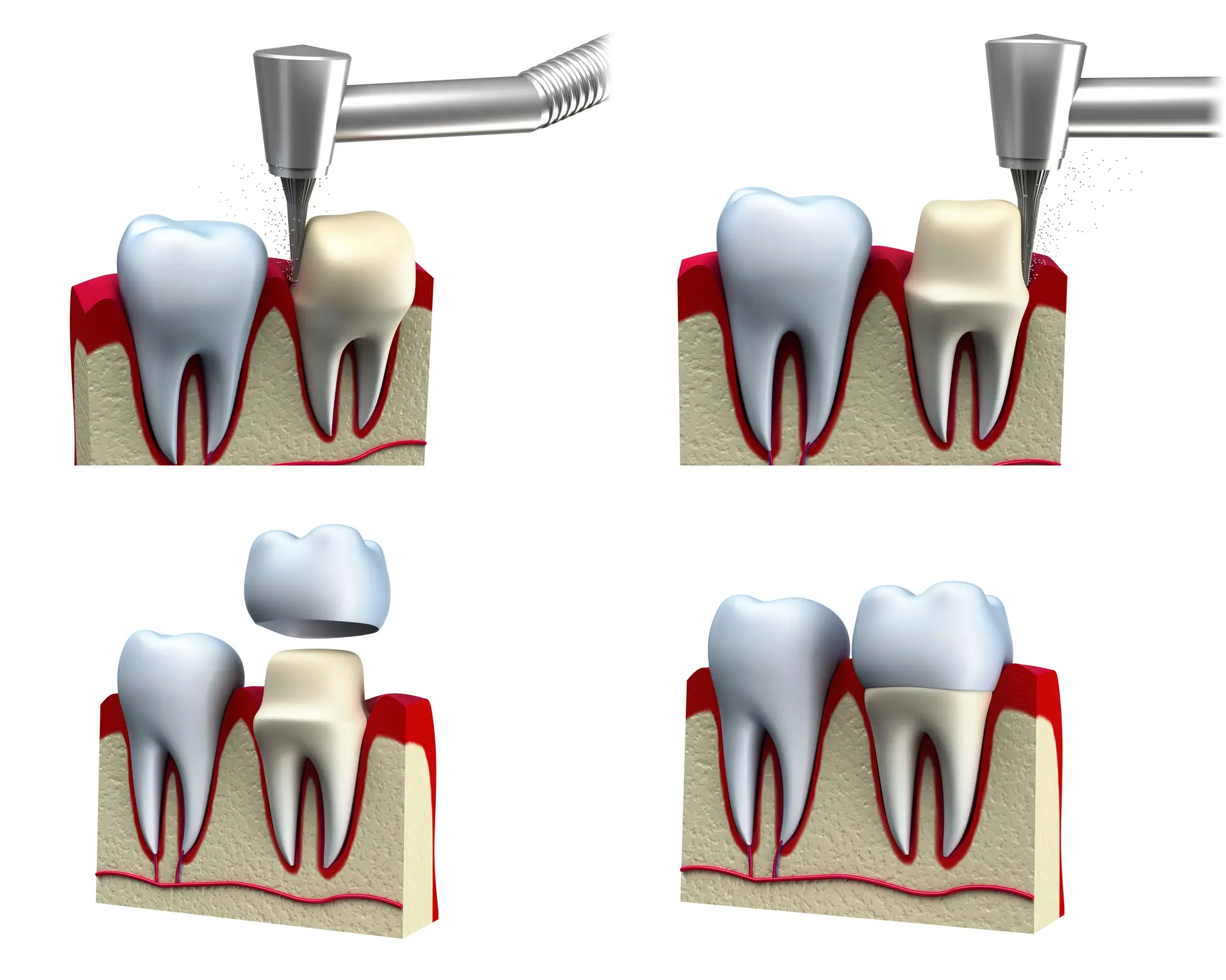 Dental crowns in New Rochelle installation process illustration