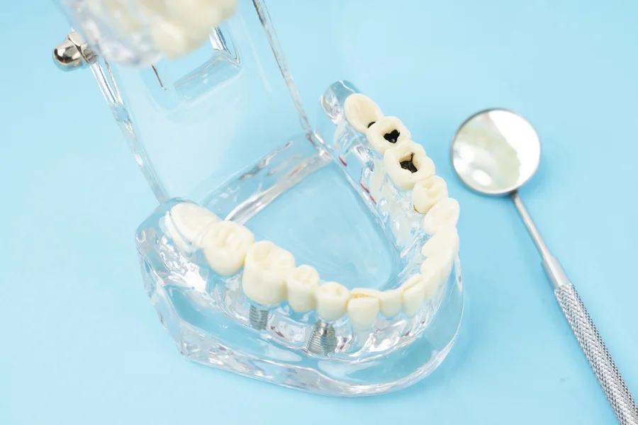 dental-fillings-treatment-cherry-hill-nj-model-showing-cavities-and-mirror (1)