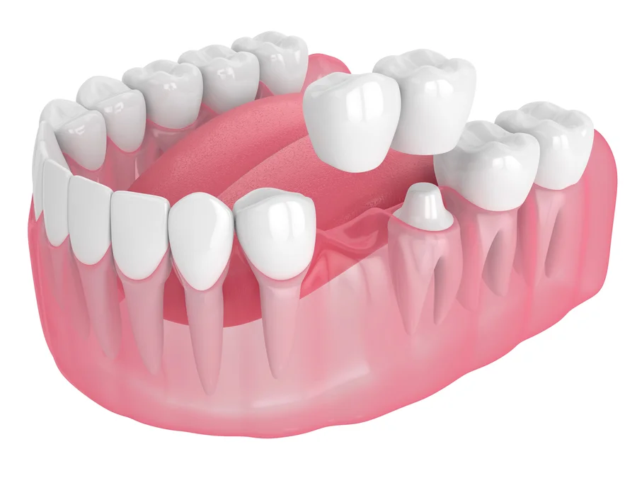 dental-bridges-cherry-hill-nj-3d-bridge-placement-model