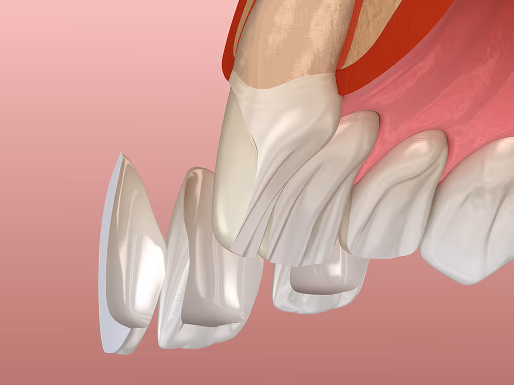 3D-Darstellung von Zahnverblendungen (Veneers), die auf vorbereitete Vorderflächen von Schneidezähnen aufgebracht werden.