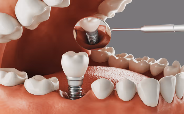 3D-Darstellung eines Zahnimplantats im Unterkiefer mit einem Zahnspiegel, der die Schraube des Implantats zeigt.