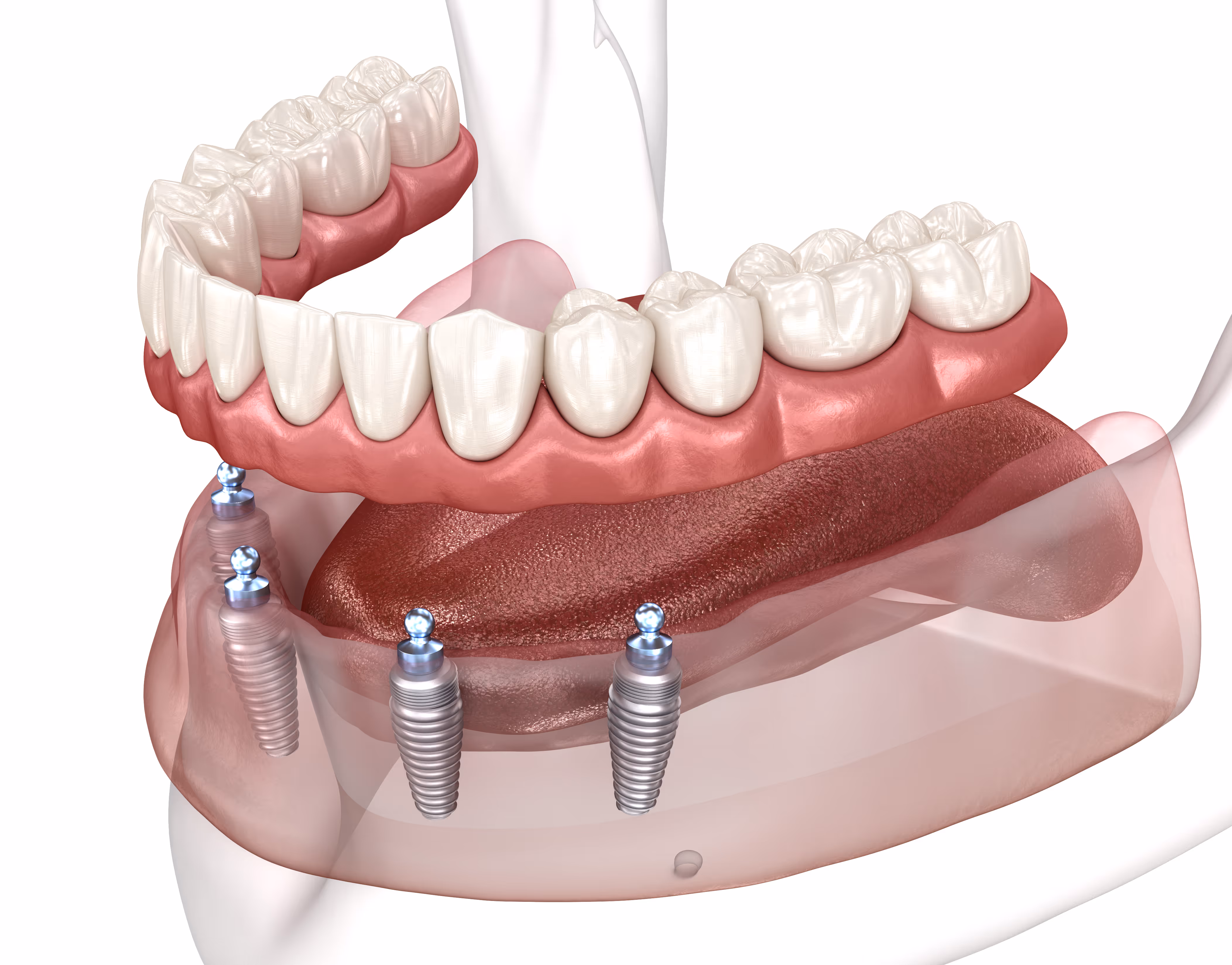 3D-Modell einer Unterkiefer-Prothese, die auf vier Implantaten befestigt ist, mit sichtbaren Zahnimplantatschrauben und natürlichem Zahnfleisch.