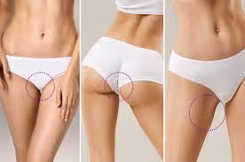 Peeling Químico en Zonas Íntimas