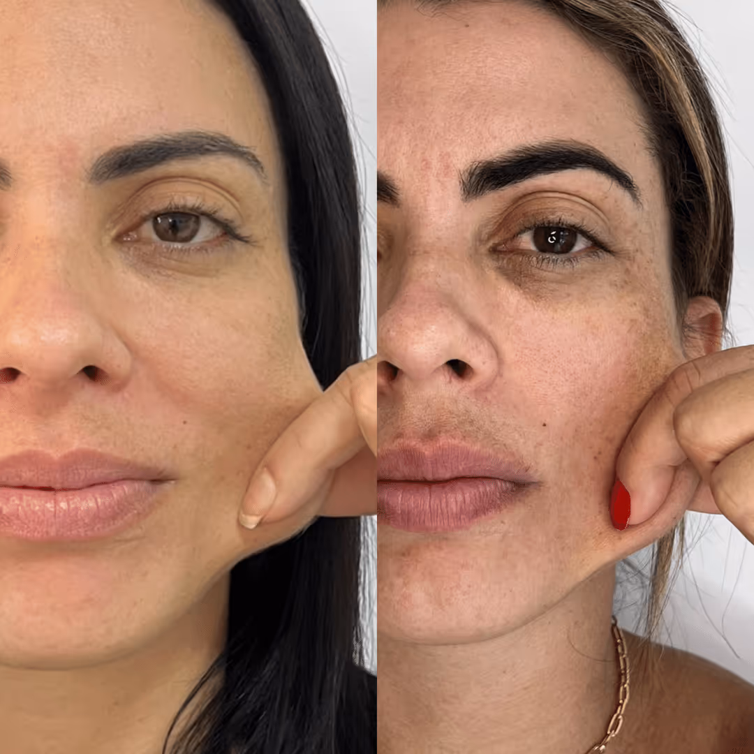 Estimulador de Colágeno Facial