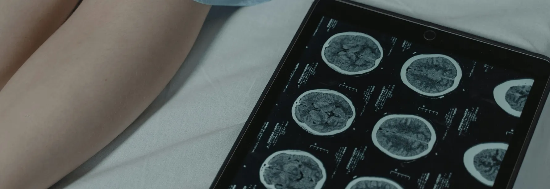 A set of brain scans lies next to a patient in a hospital bed, indicating a serious condition of the brain in Los Angeles