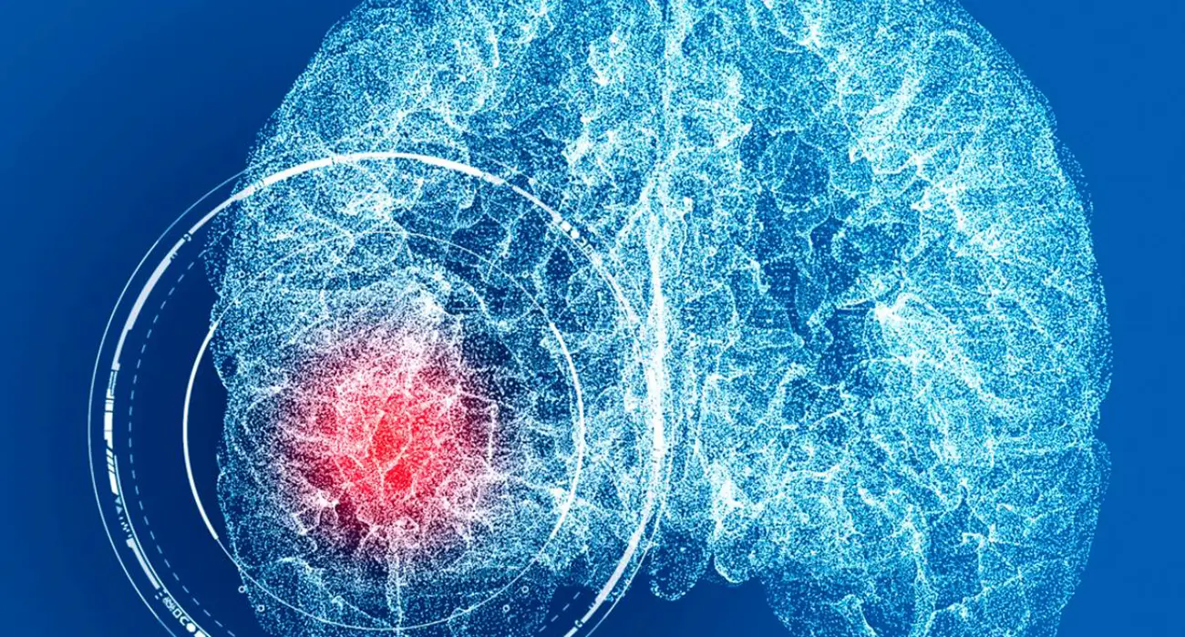Illustration of a brain artery with a small bulging cerebral aneurysm