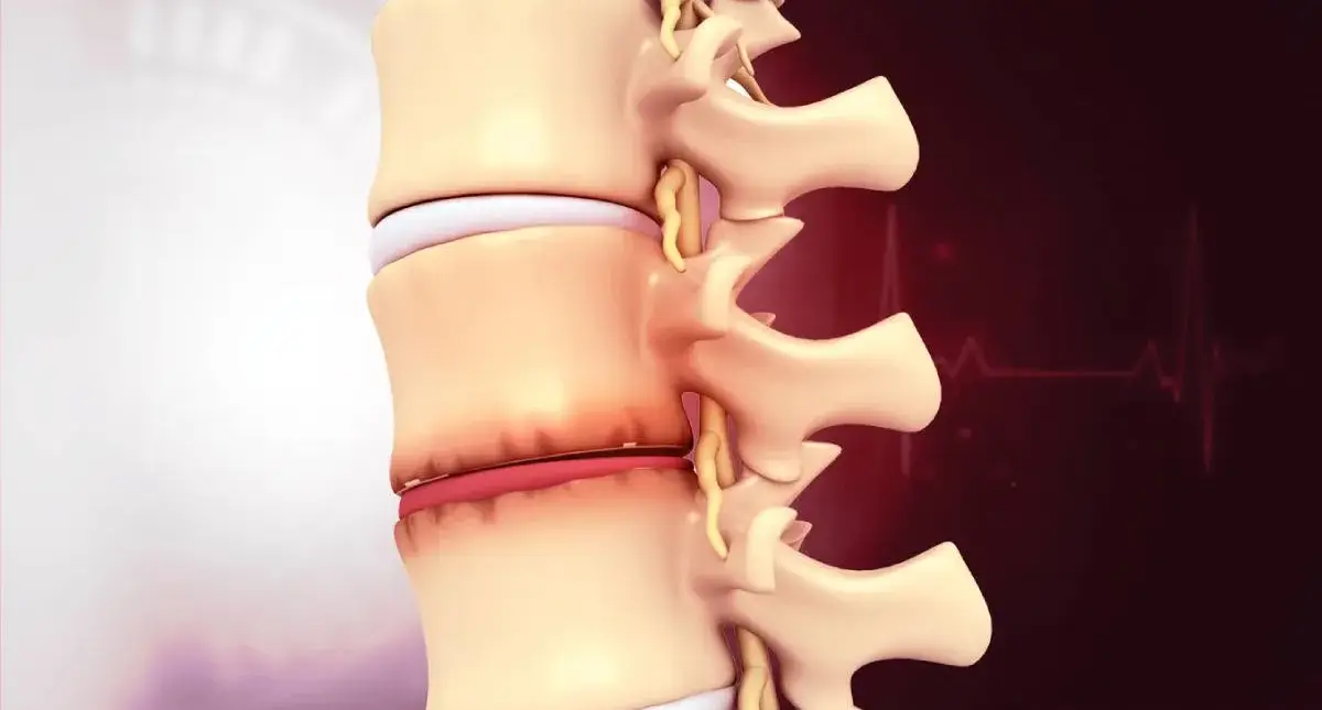 Lumbar spine model showing an intervertebral disc and an artificial disc implant used in disc replacement surgery
