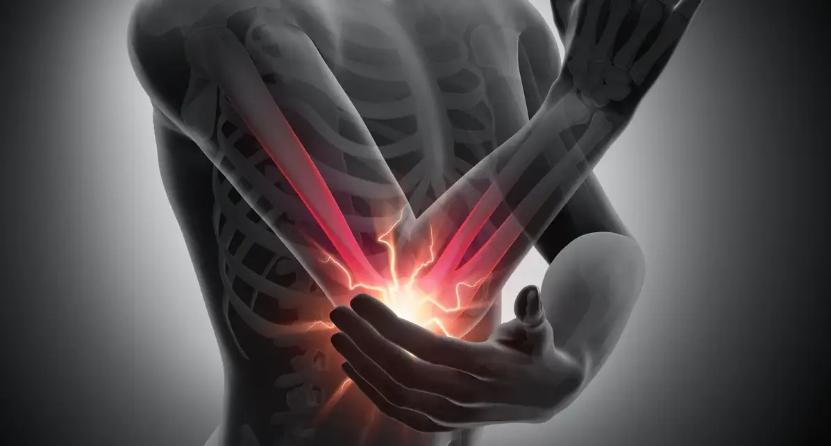 Illustration showing cartilage wear and bone spur formation in an arthritic spine facet joint